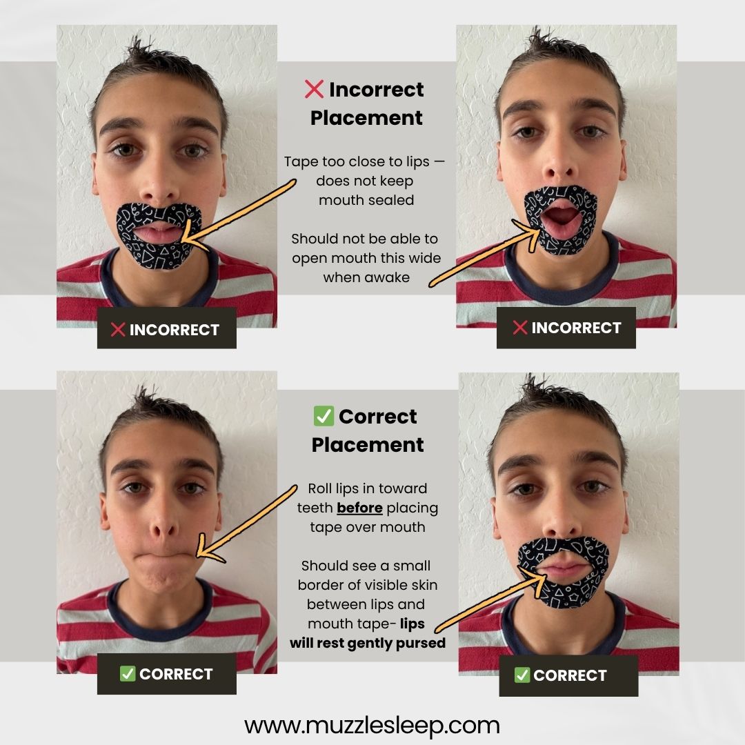 Muzzle® Mouth Tape For Youth (Medium Hold)